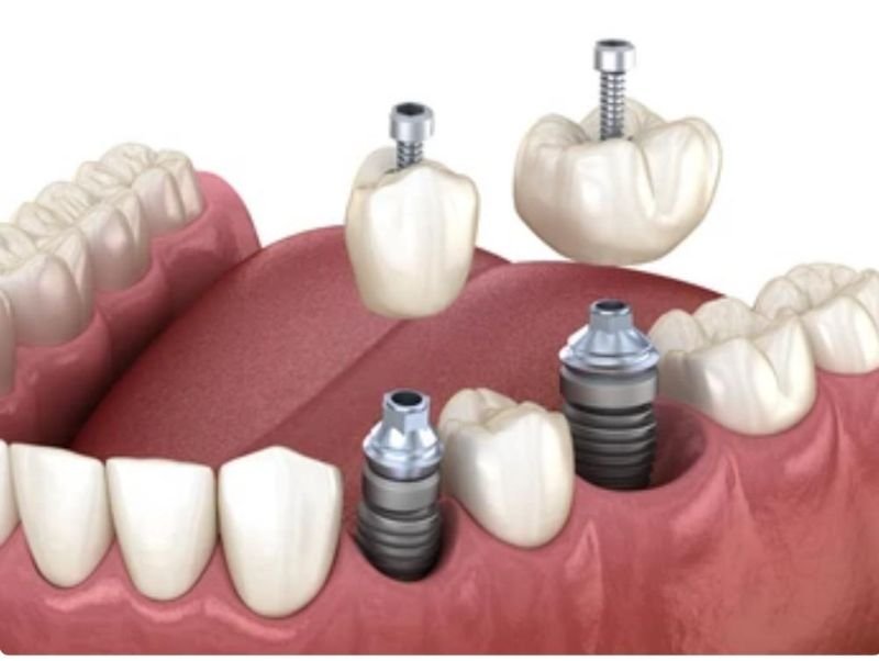 Implantes Dentales