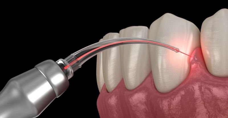 Periodoncia Avanzada